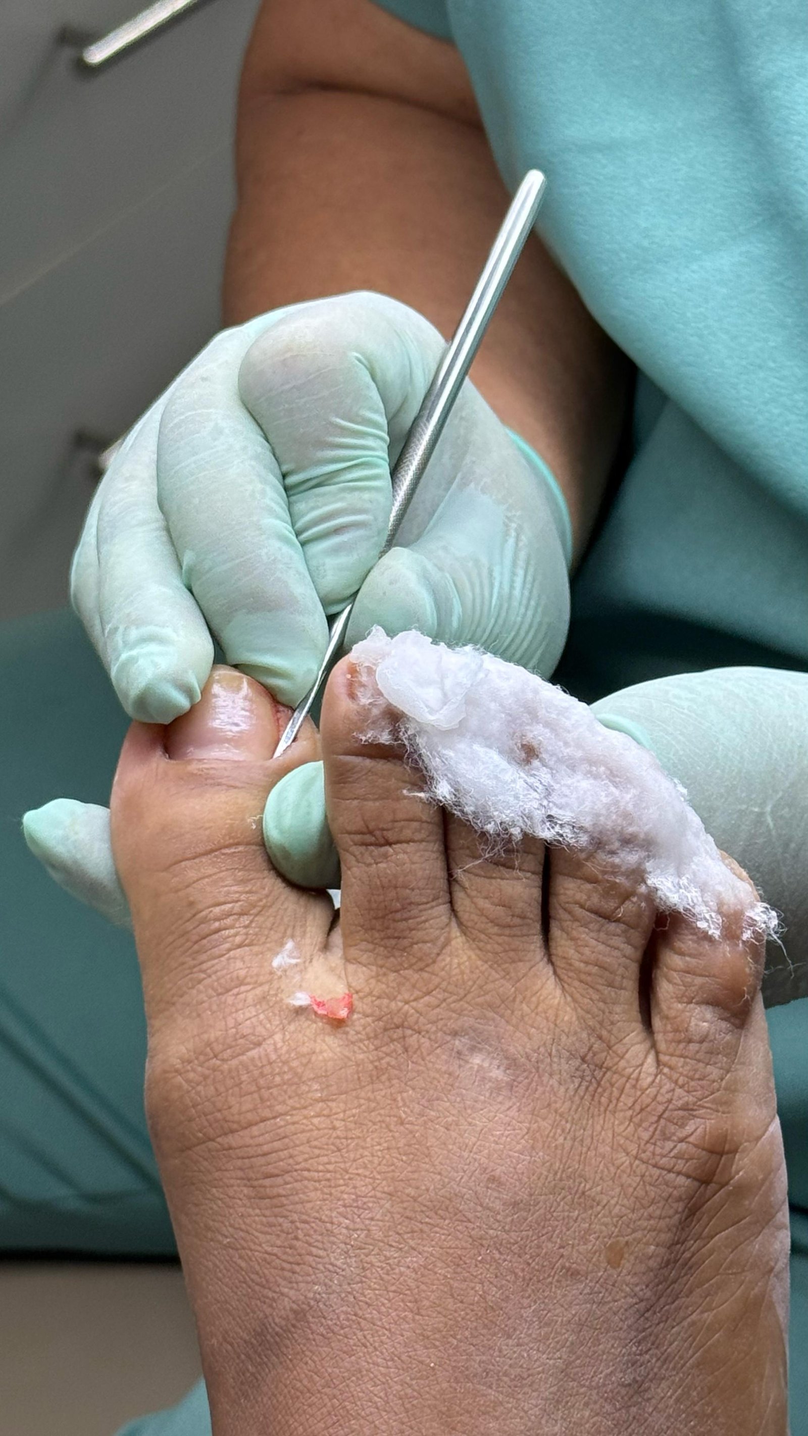 Tratamento de unhas encravadas